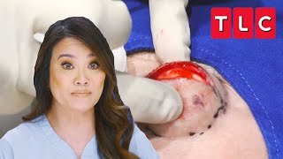 Dr Lee Squeezes “Devil Horn” Cyst off the Forehead of a Patient  Dr Pimple Popper  TLC [upl. by Eillim]