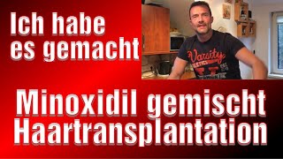 Haartransplantation Minoxidil Anleitung Istanbul Finasterid Geheimratsecken Erfahrung [upl. by Kcered]