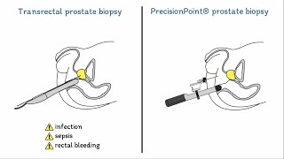 Prostate Biopsies Explained Transrectal vs PrecisionPoint® [upl. by Eseenaj674]