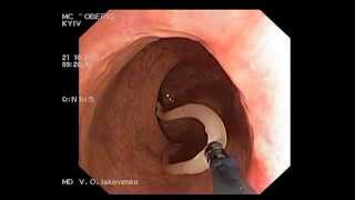 Ascaridosis on colonoscopy Аскариды при колоноскопии [upl. by Yvan]