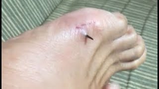 Satisfying Splinter Removal Video  big splinter in foot [upl. by Nnayrb]