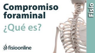 Compromiso foraminal o del neuroforamen  ¿Qué es [upl. by Einama]