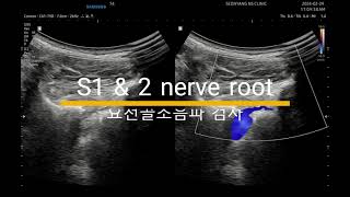 허리 골반 천장관절 통증 S1 and 2 nerve root [upl. by Onateyac]