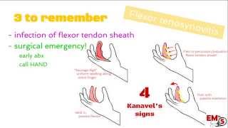 Flexor Tenosynovitis [upl. by Adalheid]