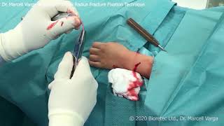 Distal radius fracture fixation with bioabsorbable implant ActivaPin™ Technique by Dr Varga [upl. by Ahen]