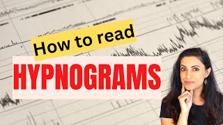 Understanding Hypnograms An Essential Guide for Clinicians [upl. by Nivac]