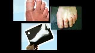 How to Fix Hammer Toe On Children [upl. by Enelak]