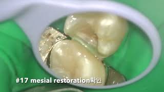 26 partial pulpectomy amp 27 proximal occlusal resin restoration [upl. by Aicissej]