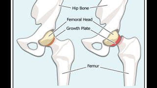 Slipped Capital Femoral Epiphysis SCFE [upl. by Anavlis]