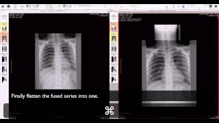 OsiriX  manual fusion of two series [upl. by Nirehtac]