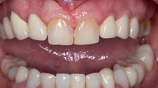 Gum retraction  preparation of Teeth for veneers  preparation of Teeth for crowns [upl. by Jezrdna]