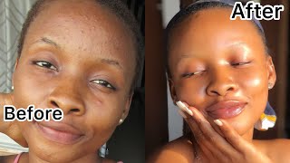 How I Truly Got Rid Of My Pimples In 2 Weeks  Clear Skin [upl. by Borras884]