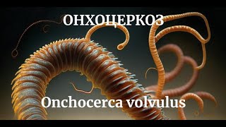 ОНХОЦЕРКОЗ Onchocerca volvulus МЕДИЦИНСКАЯ ПАРАЗИТОЛОГИЯ  Морфология Симптомы Диагностика Цикл [upl. by Bartie]