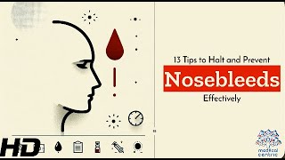 13 LifeChanging Tips to Stop Nosebleeds Before They Start [upl. by Ahsemaj759]