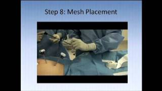 SAGES Pearls Session Laparoscopic Inguinal Hernia Repair Introduction  Technique Video [upl. by Gnex899]