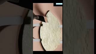 Tracheostomy procedure explained facts 3danimationfact funfacts [upl. by Zeba]