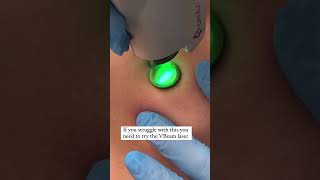 Vbeam laser for broken capillariesveins amp rosacea vbeam rosacea skincaretips [upl. by Frost]