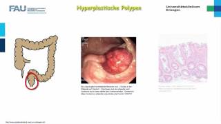 Pathologie ─ Darmerkrankungen [upl. by Alor]