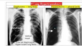 شرح أشعة الصدر Chest xRays د محمود سويلم [upl. by Snowber337]