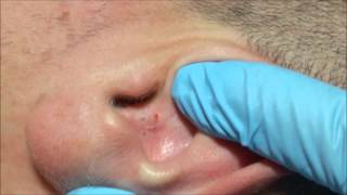 Ángels Acne Treatment Blackheads on the Ear [upl. by Dibb]