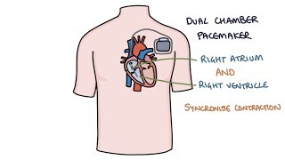 Understanding Pacemakers [upl. by Marb]