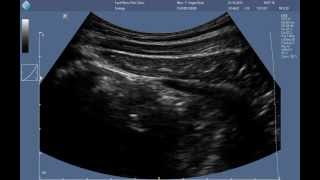 Abdominal RUSI ultrasound  correct contraction of the transversus abdominis [upl. by Denny]