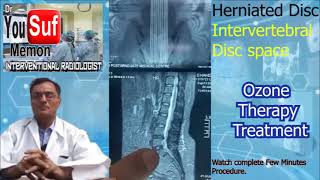 Disc Herniated  Intervertebral Disc Space Treatment  Ozone Injection  Dr Yousuf Memon Case8809 [upl. by Eselahs]