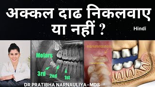 अक्कल दाढ निकलवाए या नहीं  अक्कल दाढ़ दर्द का इलाज  Wisdom Teeth Removal  DrPratibhaMDS [upl. by Breana]