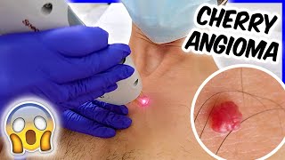 I FOUND A RED MOLE Laser Surgery  QampA  Cherry Angioma Removal [upl. by Loralie]