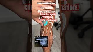 🔥✅💯How to check bursitis Prepatellar bursitis clinical examinationclinicalexaminationbursitisyt [upl. by Allista]