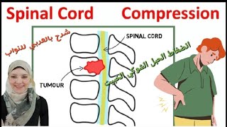 Malignant spinal cord compression بالعربي causes symptoms diagnosis treatment RT Technique [upl. by Aiekan]