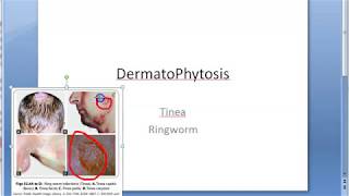 Microbiology 573 a DermatoPhytosis RingWorm Trichophyton Microsporum Epidermophyton ID reaction [upl. by Aillil]