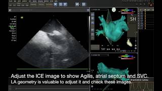 Transseptal puncture using CARTO3 system  ZeroFluoroscopy technique [upl. by Nnylyrehc]