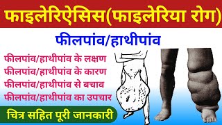 फाइलेरिऐसिस फाइलेरिया रोग  filaria ke lakshan  filariasis  elephantiasis  फीलपांव  हाथीपांव [upl. by Enotna]