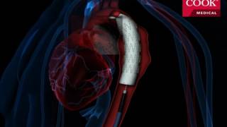 Thoracic Endovascular Aortic Repair TEVAR [upl. by Launce255]