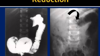 Intussusception Reduction HowTo [upl. by Gage]