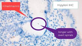 Histology of Helicobacter pylori gastritis [upl. by Baal574]