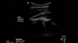 Shoulder Ultrasound Posterior Shoulder Dislocation [upl. by Suk]