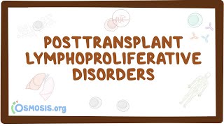 Posttransplant lymphoproliferative disorders  causes symptoms diagnosis treatment pathology [upl. by Standing]