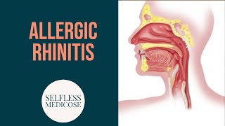 ALLERGIC RHINITIS complete explanation part 2 [upl. by Buzz586]