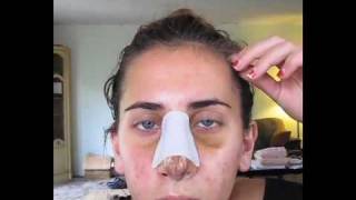 VLog of my Rhinoplasty Surgery Recovery 6 [upl. by Pedaiah897]