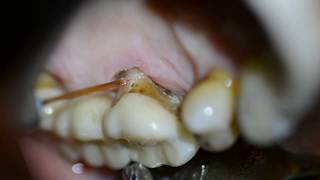 Periodontal Disease Management  Waterlase Laser Dentistry Desai [upl. by Moreno]