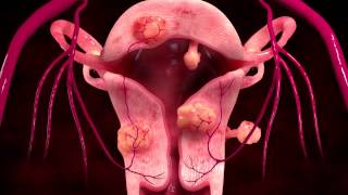 Uterine Fibroid Embolization Treatment [upl. by Zehe]