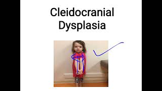 cleidocranial dysplasia [upl. by Yentruocal167]