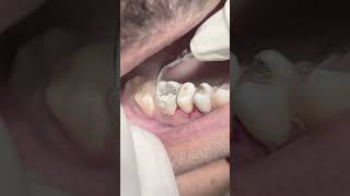 Scaling and cleaning tartar amp calculus dentistteeth dentist satisfying [upl. by Parent838]