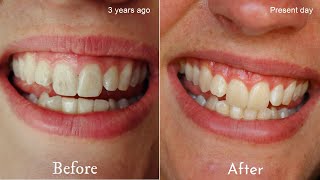 DIY Remineralising Toothpaste  Restore tooth enamel naturally [upl. by Glori]