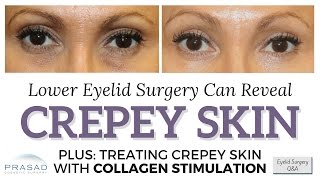 How Eye Bags can Camouflage Crepey Lower Eyelid Skin and Options for Treatment [upl. by Krischer255]