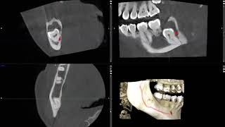 cyst or tumor in the jaw unknown lesion imaged on CBCT [upl. by Berey673]