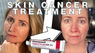 Chantelles Fluorouracil Skin Cancer Treatment  Skin Deep [upl. by Eillod]