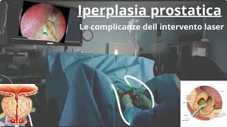 Prostata ingrossata Le complicanze dell intervento chirurgico [upl. by Atinav]